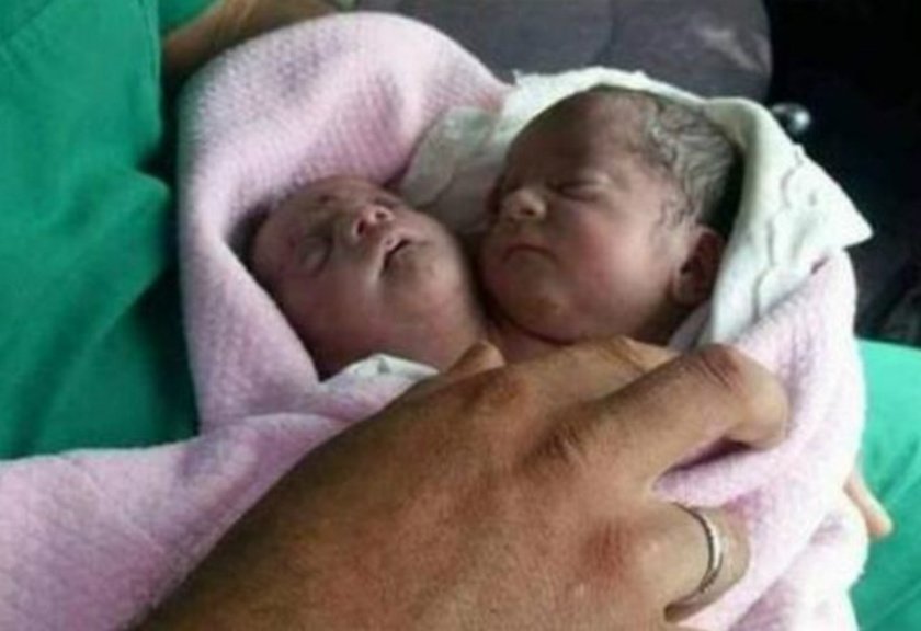  Kembar Tak Sempurna, Bayi Ini Lahir dengan Dua Kepala 