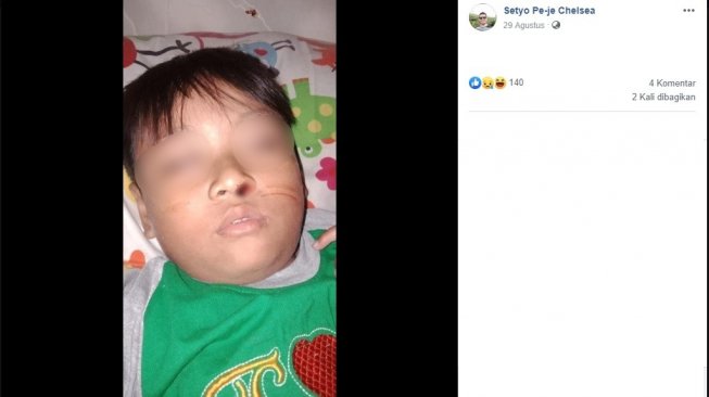 Viral Bocah Asal Solo Mimisan Sebulan, Ternyata Gara-gara Lintah!