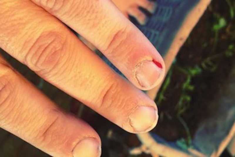 Goresan Luka Menyebabkan Seorang Ibu Meninggal Goresan Luka Menyebabkan Seorang Ibu Meninggal
