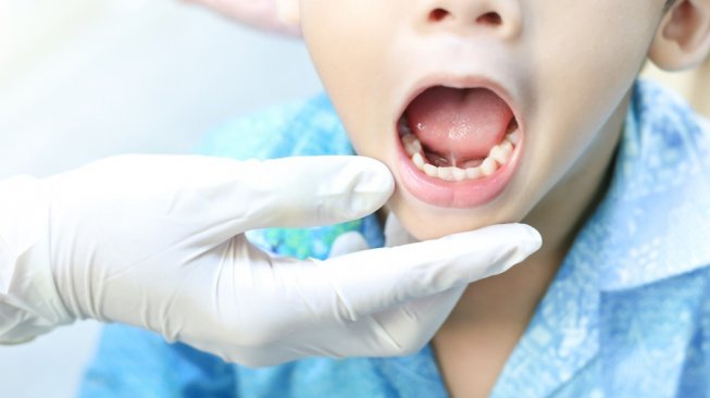 Ini 9 Penyebab Gigi Berlubang yang Sering Dianggap Remeh
