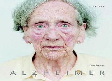 Kondisi Kulit Kemerahan Bisa Berisiko Alzheimer Kondisi Kulit Kemerahan Bisa Berisiko Alzheimer