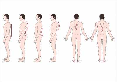 Mengenal Berbagai Kelainan Tulang Belakang: Skoliosis, Kifosis, dan Lordosis