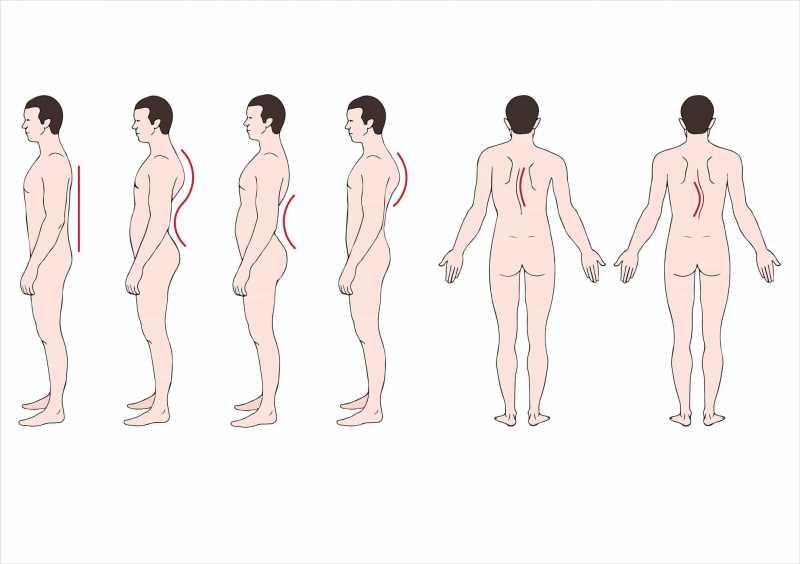 Mengenal Berbagai Kelainan Tulang Belakang: Skoliosis, Kifosis, dan Lordosis Mengenal Berbagai Kelainan Tulang Belakang: Skoliosis, Kifosis, dan Lordosis