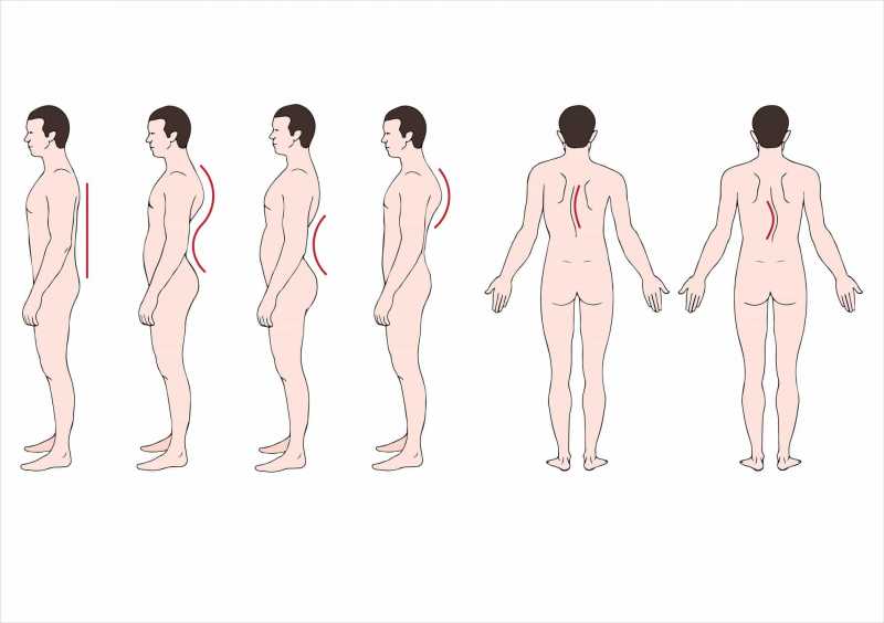 Mengenal Berbagai Kelainan Tulang Belakang: Skoliosis, Kifosis, dan Lordosis