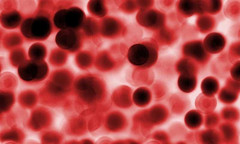 5 Gejala Utama Leukimia 5 Gejala Utama Leukimia