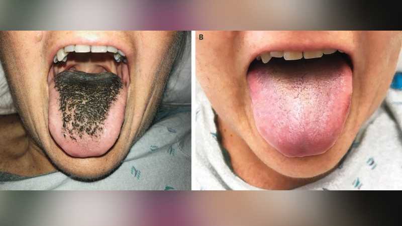 Lidah Perempuan Ini Ditumbuhi Rambut akibat Diinfus Antibiotik Lidah Perempuan Ini Ditumbuhi Rambut akibat Diinfus Antibiotik
