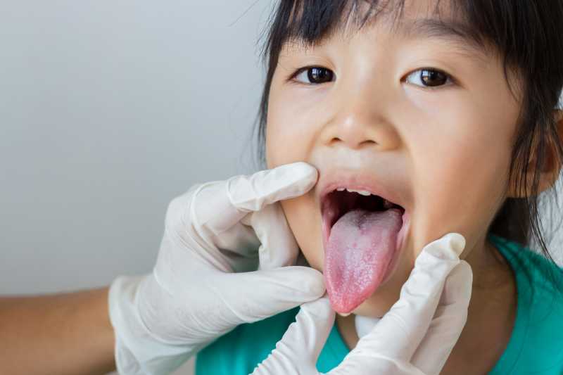 Oral Thrush, Infeksi Jamur di Mulut yang Bisa Menyerang Bayi dan Orang Dewasa Oral Thrush, Infeksi Jamur di Mulut yang Bisa Menyerang Bayi dan Orang Dewasa