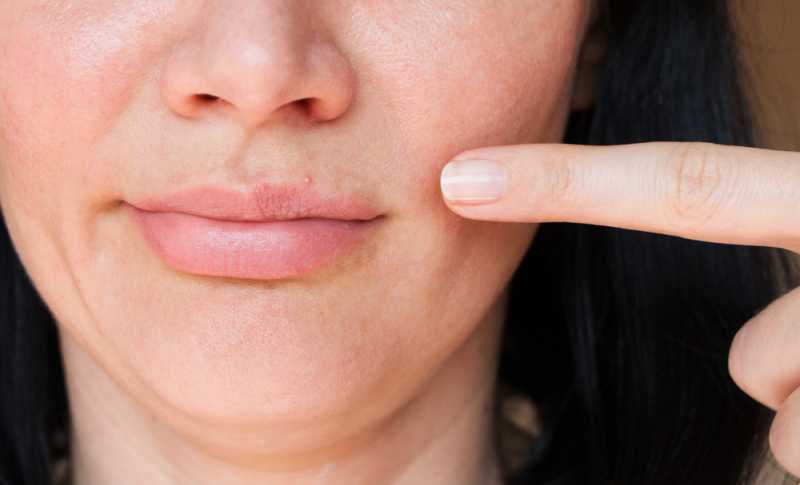 5 Kiat Mujarab untuk Membantu Mengatasi Jerawat di Bibir 5 Kiat Mujarab untuk Membantu Mengatasi Jerawat di Bibir