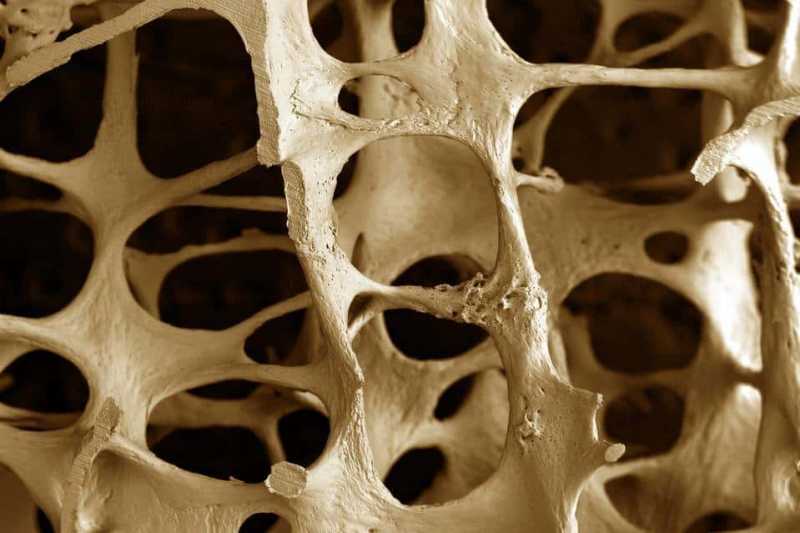 4 Hal yang Mempercepat Pengeroposan Tulang